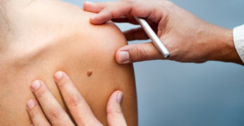 Особенности метастазирования меланомы